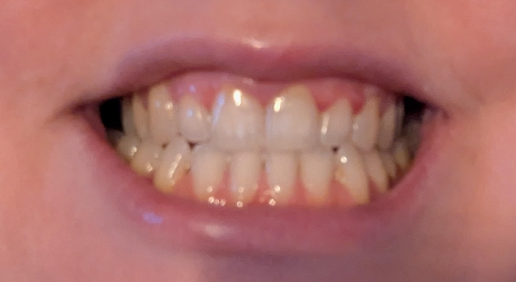 Crest 3DWhitestrips Sensitive White At-Home Teeth Whitening Kit, 18 Treatments, Gently Removes 15 Years of Stains customer photo 1