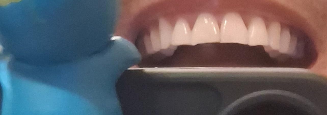 Crest 3D Whitestrips Sensitive & Gentle + LED Light - Teeth Whitening Kit, 1 Light + 14 Treatments, Each with 1 Upper/1Lower, 28 Strips - Crest 3DWhite Teeth Whitening Strips customer photo 1