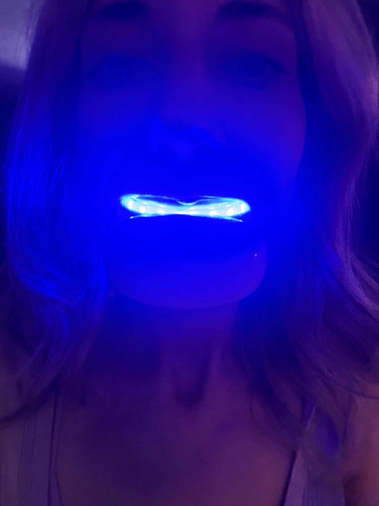 Whitebite Pro Teeth Whitening Kit for Sensitive Teeth - 32X LED Light + 35% Carbamide Peroxide Gel + Remineralizing Gel | Dental-Grade Whitening at Home customer photo 1